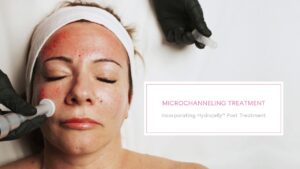 Microchannelling Treatment